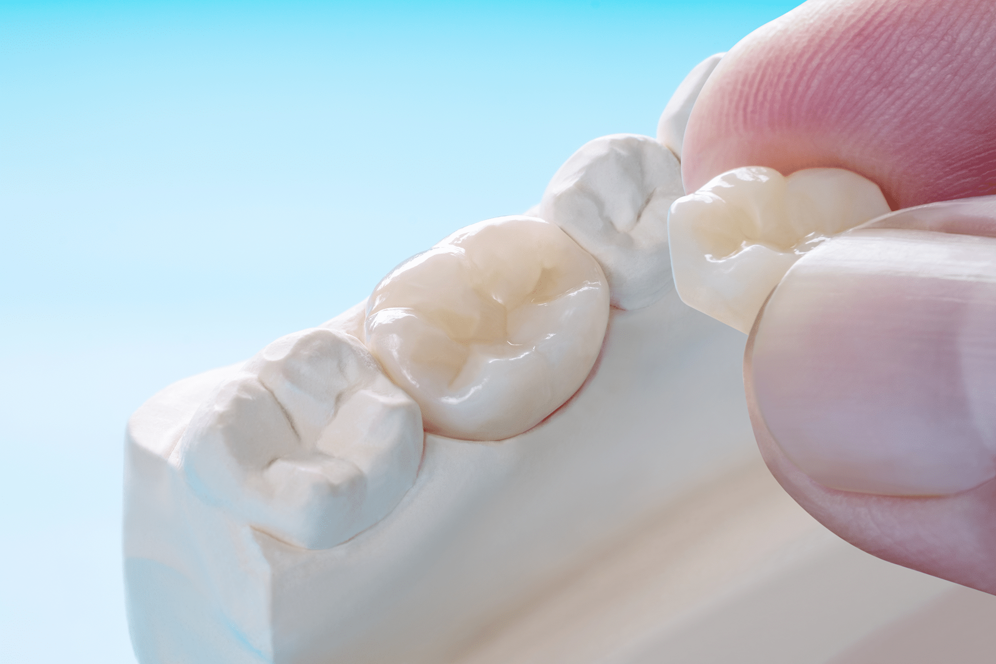 dental crowns roseville