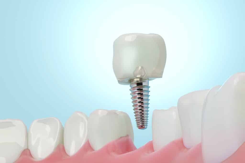 dental implants near me